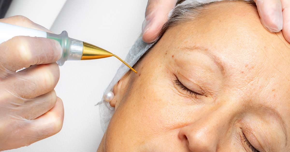 Jato de Plasma - Blefaroplastia - imagem 1